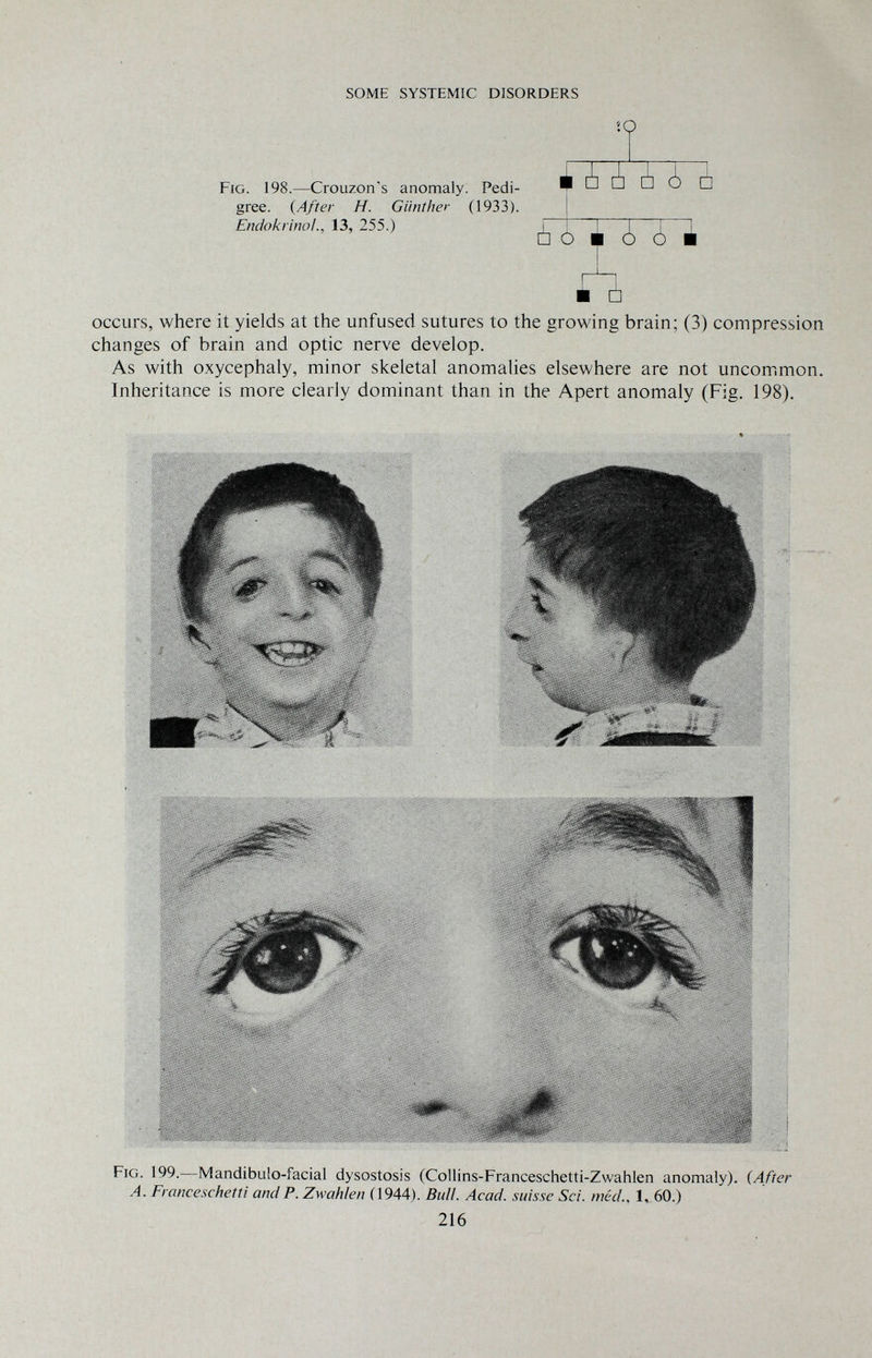 SOME SYSTEMIC DISORDERS IQ Fig. 198.—Crouzon's anomaly. Pedi¬ gree. (After H. Günther (1933). Endokrinol., 13, 255.) à ó i ¿ ¿ ¿ ¿ □ É ¿ ¿ ■ occurs, where it yields at the unfused sutures to the growing brain; (3) compression changes of brain and optic nerve develop. As with oxycephaly, minor skeletal anomalies elsewhere are not uncommon. Inheritance is more clearly dominant than in the Apert anomaly (Fig. 198). Fig. 199.—Mandibulo-facial dysostosis (Collins-Franceschetti-Zwahlen anomaly). (After A. Franceschetti and P. Zwahlen (1944). Bull. Acad, suisse Sci. méd., 1, 60.) 216