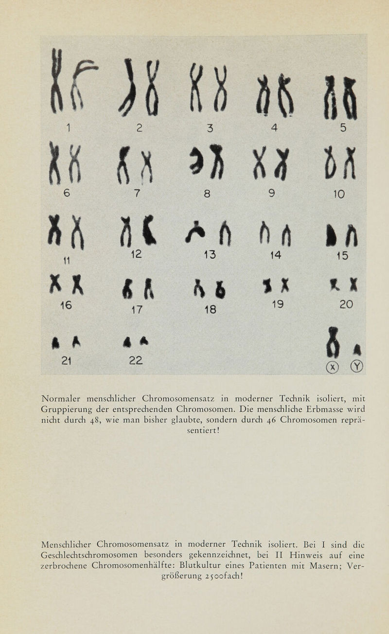 H 11 к 16 A ^ 21 Normaler menschlicher Chromosomensatz in moderner Technik isoliert, mit Gruppierung der entsprechenden Chromosomen. Die menschliche Erbmasse wird nicht durch 48, wie man bisher glaubte, sondern durch 46 Chromosomen reprä¬ sentiert! Menschlicher Chromosomensatz in moderner Technik isoliert. Bei I sind die Geschlechtschromosomen besonders gekennzeichnet, bei II Hinweis auf eine zerbrochene Chromosomenhälfte: Blutkultur eines Patienten mit Masern; Ver¬ größerung 25oofach!