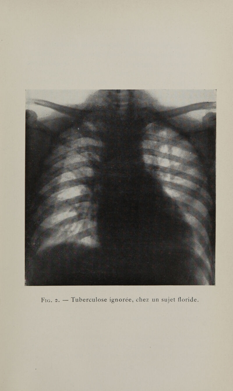 Fig. 2. — Tuberculose ignorée, chez un sujet floride.