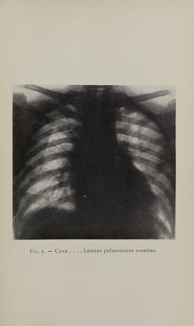 Fig. 5. — Char .... Lésions pulmonaires muettes.