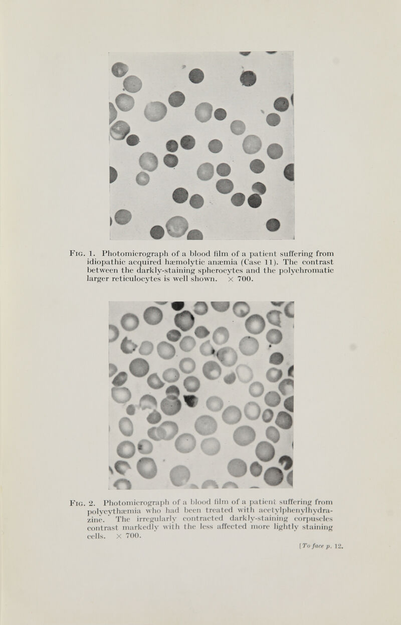 ST® ®* •• • » f* et z « •o» • Fig. 1. Photomicrograph of a blood film of a patient suffering from idiopathic acquired liœmolytic anaemia (Case 11). The contrast between the darkly-staining spherocytes and the polycliromatic larger reticulocytes is лусП shown. x 700. OO Oo ' Fig. 2. Photomicrograph of a blood film of a j)aticnl suffering from polycythivmia луЬо had been treated л\ч111 acetyl¡)hcnylhydra- zinè. The irregularly contracted darkly-staining corijuscles contrast markedly with the less affected more lightly staining cells. X 700. [To face p. 12.