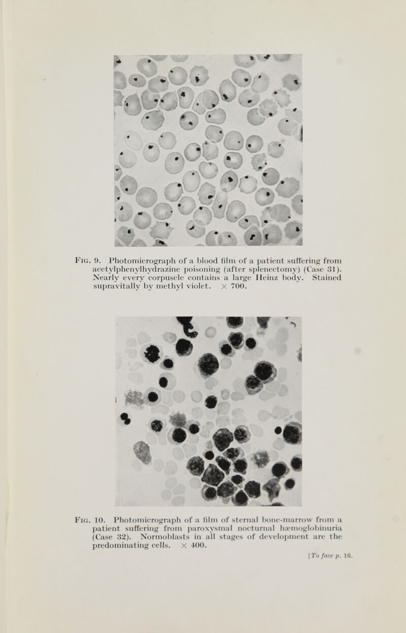 Fig. 9. Photomicrograph of a blood film of a patient suffering from acetylphenylhydrazine poisoning (after sjileneetoniy) (Case 31). Nearly every corjiusele contains a large Heinz body. Stained supravitally by methyl violet. X 700. г ш W 'Wm Л w - i * *■ * *$• #• •« Fig. 10. Photomicrograph of a lilin of sternal bone-marrow from a patient suffering from ])aroxysmal nocturnal ha-mogiobinuria (Case :52). Normoblasts in all stages of develoi)ment are the predominating cells. X 400. [To face p. 10.