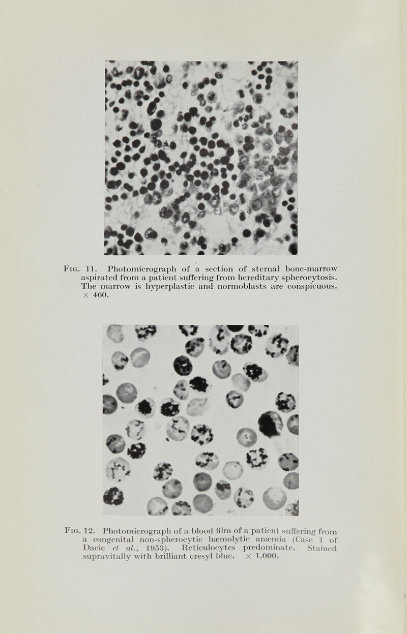 P«**ÎV* 'f* * »«• tfci/v Fig. 11. Photomicrograph of a section of sternal bone-marrow aspirated from a patient suffering from hereditary spherocytosis. The marrow is hyperplastic and normoblasts are conspicuous. X 460. tft J! 'A тИГ f 1^ ■ 0 i 4 m Fig. 12. Photomicrograph of a blood film of a patient suffering from a congenital non-spherocytic haemolytic anaemia (Case 1 of Dacie et al., 1953). Reticulocytes predominate. Stained supravitally with brilliant cresyl blue, x 1,000.