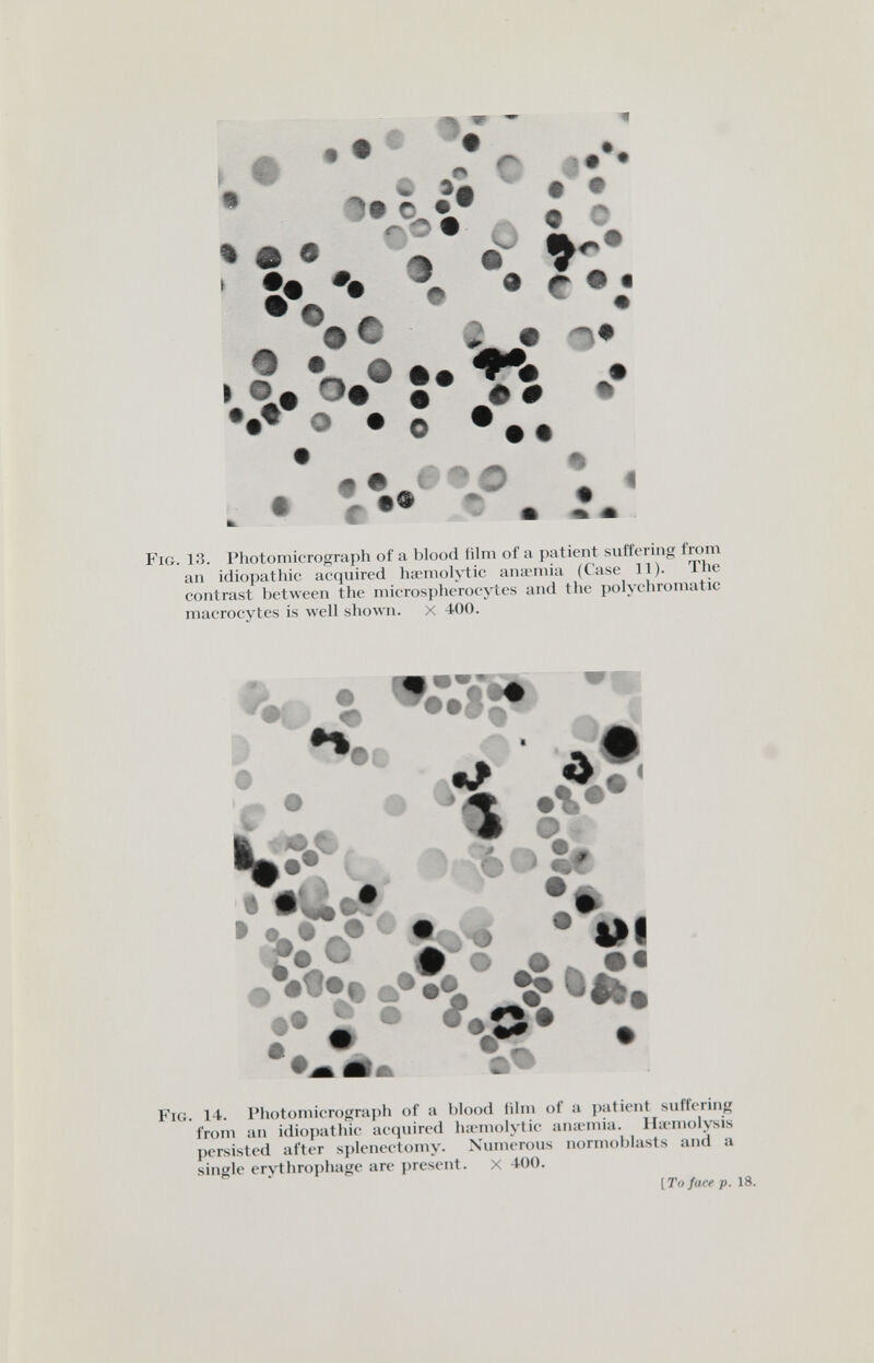 • !•% •• • • • • • ' i* • • • с ** o_ # пФ •.v °*'î*7î •• ••♦ о • о ® 4% • • ^ О I . • г t Fig. 13. PhotomicTograph of а blood film of a patient .suffering from an idiopathic acquired ha-moK-tic an;eniia (Case П). The contrast between the niicrospherocytes and the polychromatic macrocvtes is well shown. x 400. € Je - ■ -Д# Äe' iW % % SV J Sff > ♦ 3^ • I. - •л;®* • ill фФ 2 ® e^Q.# Fig. 14. Photomieroiiraph of a blood film of a j)atient suffering from an idiopathic acquired lurmolytic an:emia. Ha'inolysis persisted after splenectomy. Numerous normoblasts and a single erythrophage are present. X 400. [Tu face p. 18.