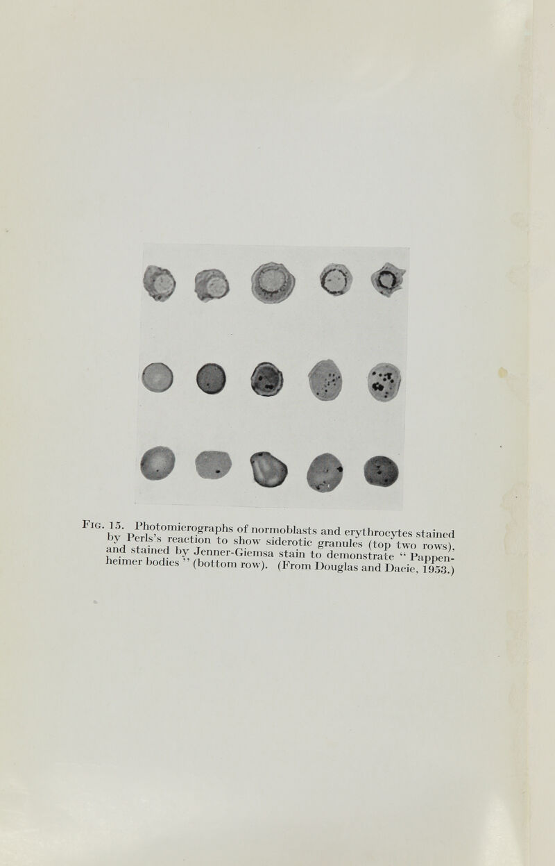Fig. 15. Photomicrographs of normoblasts and erythrocytes stained by Perls's reaction to show siderotic granules (top two rows), and stained by Jenner-Giemsa stain to demonstrate  Pappen¬ heimer bodies  (bottom row). (From Douglas and Dacie, 1953.)