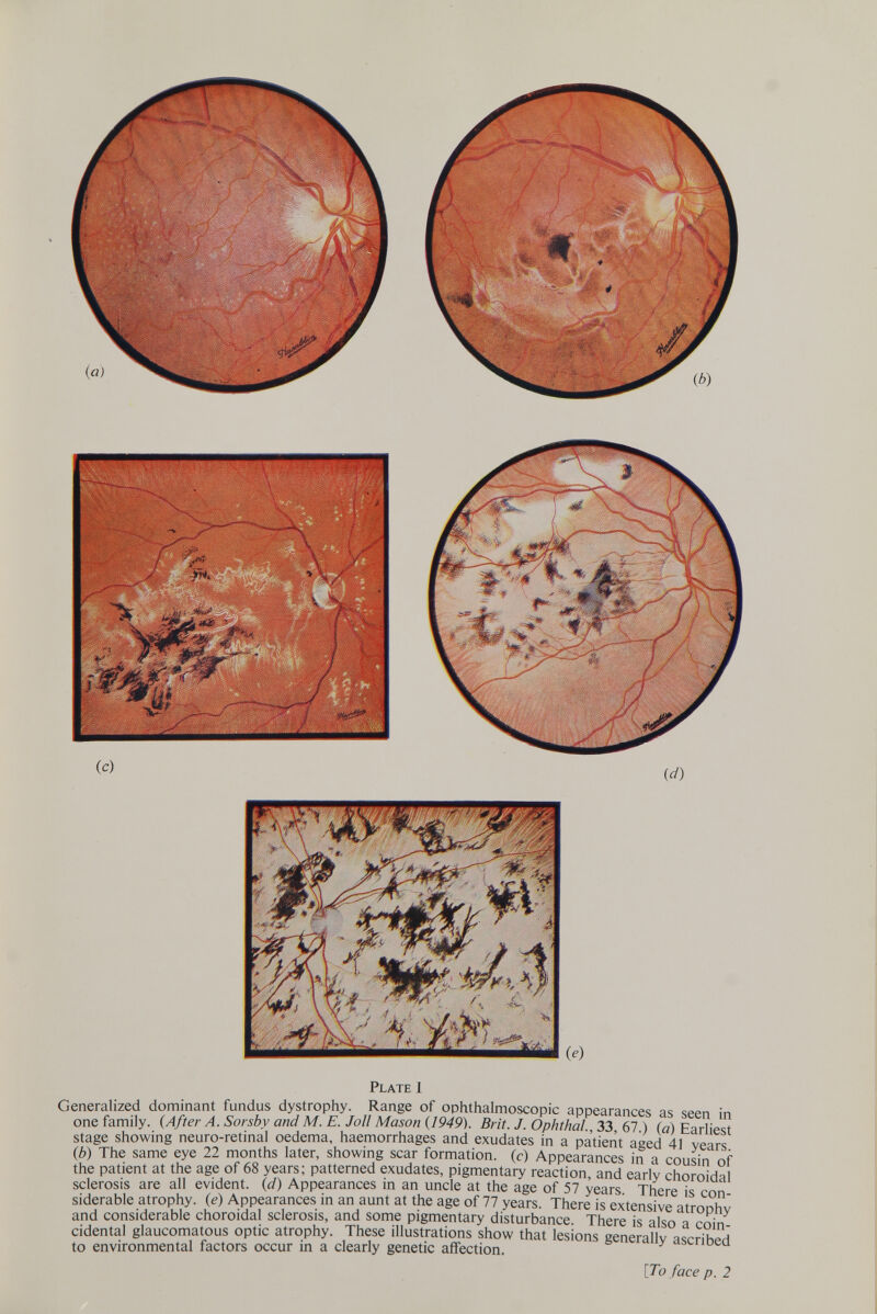 (с) id) Plate 1 Generalized dominant fundus dystrophy. Range of ophthalmoscopic appearances as seen in one family. (After A. Sorsby and M. E. JoU Mason {1949). Brit. J. Ophthal., 33, 67.) (a) Earliest stage showing neuro-retinal oedema, haemorrhages and exudates in a patient aged 41 years. (b) The same eye 22 months later, showing scar formation, (c) Appearances in a cousin of the patient at the age of 68 years; patterned exudates, pigmentary reaction, and early choroidal sclerosis are all evident, (d) Appearances in an uncle at the age of 57 years. There is con¬ siderable atrophy, (e) Appearances in an aunt at the age of 77 years. There is extensive atrophy and considerable choroidal sclerosis, and some pigmentary disturbance. There is also a coin¬ cidental glaucomatous optic atrophy. These illustrations show that lesions generally ascribed to environmental factors occur in a clearly genetic affection. [7b face p. 2