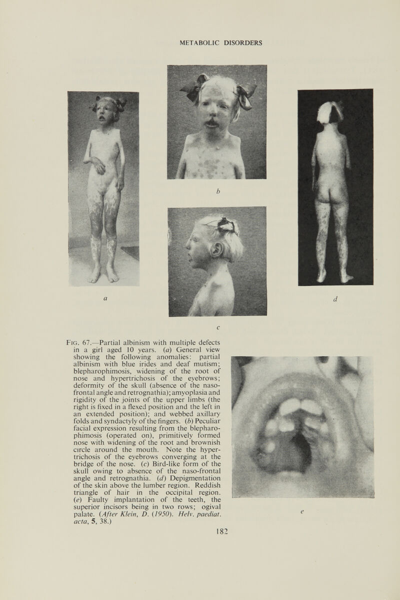 METABOLIC DISORDERS Fig. 67.—Partial albinism with multiple defects in a girl aged 10 years, (a) General view showing the following anomalies; partial albinism with blue irides and deaf mutism; blepharophimosis, widening of the root of nose and hypertrichosis of the eyebrows; deformity of the skull (absence of the naso¬ frontal angle and retrognathia); amyoplasia and rigidity of the joints of the upper limbs (the right is fixed in a flexed position and the left in an extended position); and webbed axillary folds and syndactyly of the fingers, (b) Peculiar facial expression resulting from the blepharo¬ phimosis (operated on), primitively formed nose with widening of the root and brownish circle around the mouth. Note the hyper¬ trichosis of the eyebrows converging at the bridge of the nose, (c) Bird-like form of the skull owing to absence of the naso-frontal angle and retrognathia. (d) Depigmentation of the skin above the lumber region. Reddish triangle of hair in the occipital region. j (e) Faulty implantation of the teeth, the superior incisors being in two rows; ogival palate. (After Klein, D. {1950). Helv. paediat. acta, 5, 38.) 182