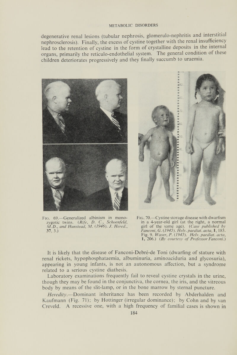 METABOLIC DISORDERS degenerative renal lesions (tubular nephrosis, glomerulo-nephritis and interstitial nephrosclerosis). Finally, the excess of cystine together with the renal insufficiency lead to the retention of cystine in the form of crystalline deposits in the internal organs, primarily the reticulo-endothelial system. The general condition of these children deteriorates progressively and they finally succumb to uraemia. Fig. 69.—Generalized albinism in mono¬ zygotic twins. (Rife, D. C., Schoenfeld, M.D., and Himstead, M. (1946). J. Hered., 37, 3.) Fig. 70.—Cystine storage disease with dwarfism in a 4-year-old girl (at the right, a normal girl of the same age). (Case published by Fanconi, G. (1945). Heb. paediat. acta, 1, 183. Fig. 9. Waser, P. (1945). Helv. paediat. acta, 1, 206.) (By courtesy of Professor Fanconi.) It is likely that the disease of Fanconi-Debré-de Toni (dwarfing of stature with renal rickets, hypophosphataemia, albuminuria, aminoaciduria and glycosuria), appearing in young infants, is not an autonomous affection, but a syndrome related to a serious cystine diathesis. Laboratory examinations frequently fail to reveal cystine crystals in the urine, though they may be found in the conjunctiva, the cornea, the iris, and the vitreous body by means of the slit-lamp, or in the bone marrow by sternal puncture. Heredity.—Dominant inheritance has been recorded by Abderhalden and Kaufmann (Fig. 71); by Hottinger (irregular dominance) ; by Cohn and by van Creveld. A recessive one, with a high frequency of familial cases is shown in 184