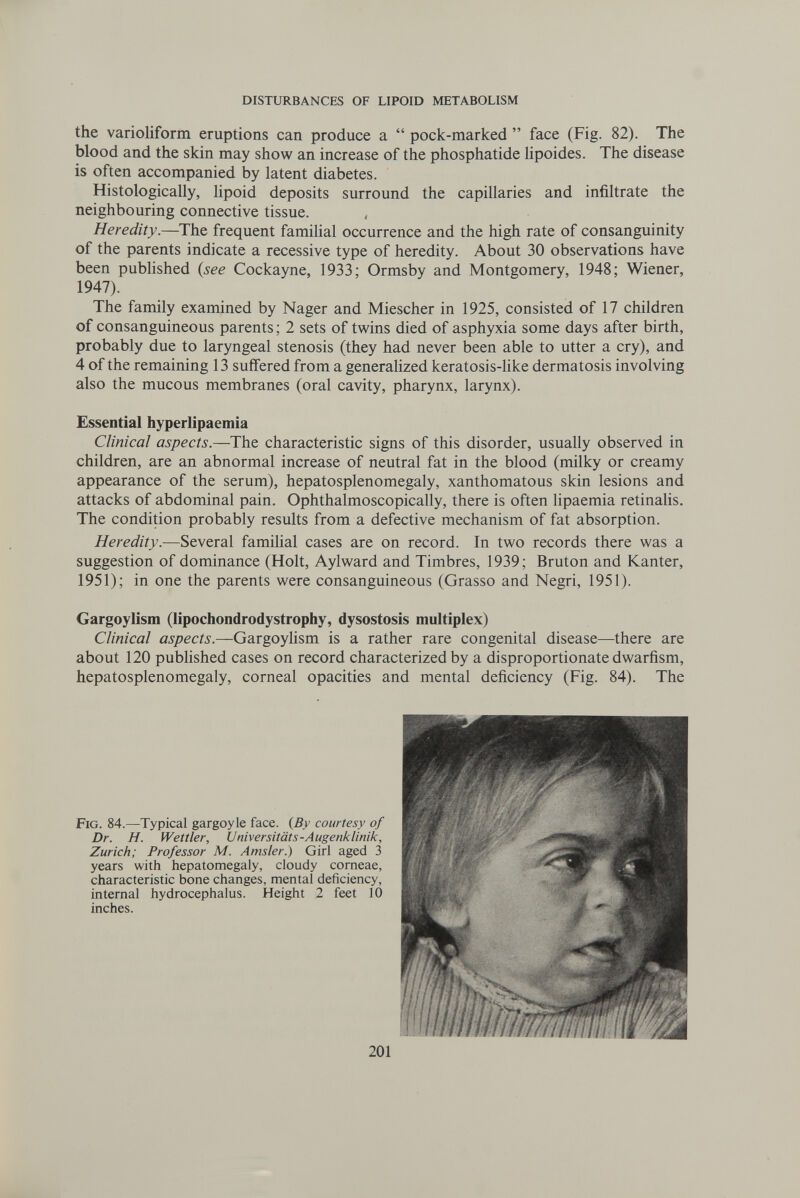 DISTURBANCES OF LIPOID METABOLISM the varioliform eruptions can produce a  pock-marked  face (Fig. 82). The blood and the skin may show an increase of the phosphatide hpoides. The disease is often accompanied by latent diabetes. Histologically, lipoid deposits surround the capillaries and infiltrate the neighbouring connective tissue. Heredity.—The frequent famihal occurrence and the high rate of consanguinity of the parents indicate a recessive type of heredity. About 30 observations have been pubhshed {see Cockayne, 1933; Ormsby and Montgomery, 1948; Wiener, 1947). The family examined by Nager and Miescher in 1925, consisted of 17 children of consanguineous parents ; 2 sets of twins died of asphyxia some days after birth, probably due to laryngeal stenosis (they had never been able to utter a cry), and 4 of the remaining 13 suffered from a generalized keratosis-like dermatosis involving also the mucous membranes (oral cavity, pharynx, larynx). Essential hyperlipaemia Clinical aspects.—The characteristic signs of this disorder, usually observed in children, are an abnormal increase of neutral fat in the blood (milky or creamy appearance of the serum), hepatosplenomegaly, xanthomatous skin lesions and attacks of abdominal pain. Ophthalmoscopically, there is often lipaemia retinalis. The condition probably results from a defective mechanism of fat absorption. Heredity.—Several familial cases are on record. In two records there was a suggestion of dominance (Holt, Aylward and Timbres, 1939; Bruton and Kanter, 1951); in one the parents were consanguineous (Grasso and Negri, 1951). Gargoylism (lipochondrodystrophy, dysostosis multiplex) Clinical aspects.—Gargoylism is a rather rare congenital disease—there are about 120 pubhshed cases on record characterized by a disproportionate dwarfism, hepatosplenomegaly, corneal opacities and mental deficiency (Fig. 84). The Fig. 84.—Typical gargoyle face. {By courtesy of Dr. H. Wettler, Universitäts-Augenklinik, Zurich; Professor M. Amsler.) Girl aged 3 years with hepatomegaly, cloudy corneae, characteristic bone changes, mental deficiency, internal hydrocephalus. Height 2 feet 10 inches. 201