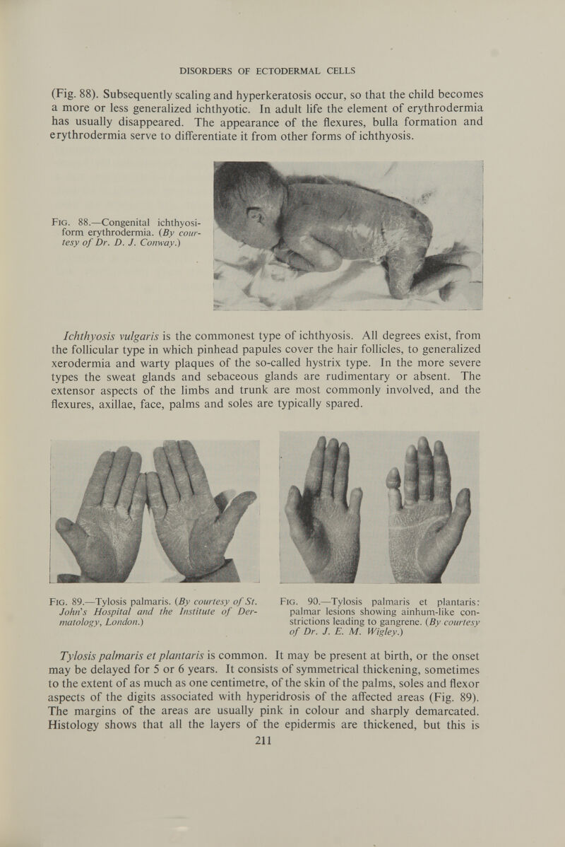 DISORDERS OF ECTODERMAL CELLS (Fig. 88). Subsequently scaling and hyperkeratosis occur, so that the child becomes a more or less generalized ichthyotic. In adult life the element of erythrodermia has usually disappeared. The appearance of the flexures, bulla formation and erythrodermia serve to differentiate it from other forms of ichthyosis. Ichthyosis vulgaris is the commonest type of ichthyosis. All degrees exist, from the follicular type in which pinhead papules cover the hair follicles, to generalized xerodermia and warty plaques of the so-called hystrix type. In the more severe types the sweat glands and sebaceous glands are rudimentary or absent. The extensor aspects of the limbs and trunk are most commonly involved, and the flexures, axillae, face, palms and soles are typically spared. Fig. 89.—Tylosis palmaris. {By courtesy of St. John's Hospital and the Institute of Der¬ matology, London.) Fig. 90.—Tylosis palmaris et plantaris: palmar lesions showing ainhum-like con¬ strictions leading to gangrene. {By courtesy of Dr. J. E. M. Wigley.) Tylosis palmaris et plantaris is common. It may be present at birth, or the onset may be delayed for 5 or 6 years. It consists of symmetrical thickening, sometimes to the extent of as much as one centimetre, of the skin of the palms, soles and flexor aspects of the digits associated with hyperidrosis of the affected areas (Fig. 89). The margins of the areas are usually pink in colour and sharply demarcated. Histology shows that all the layers of the epidermis are thickened, but this is 211