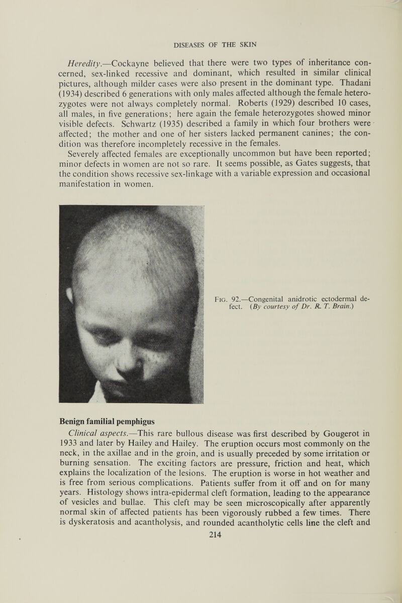 DISEASES OF THE SKIN Heredity.—Cockayne believed that there were two types of inheritance con¬ cerned, sex-hnked recessive and dominant, which resulted in similar clinical pictures, although milder cases were also present in the dominant type. Thadani (1934) described 6 generations with only males afifected although the female hetero¬ zygotes were not always completely normal. Roberts (1929) described 10 cases, all males, in five generations; here again the female heterozygotes showed minor visible defects. Schwartz (1935) described a family in which four brothers were affected; the mother and one of her sisters lacked permanent canines; the con¬ dition was therefore incompletely recessive in the females. Severely affected females are exceptionally uncommon but have been reported; minor defects in women are not so rare. It seems possible, as Gates suggests, that the condition shows recessive sex-linkage with a variable expression and occasional manifestation in women. Benign familial pemphigus Clinical aspects.—This rare bullous disease was first described by Gougerot in 1933 and later by Hailey and Hailey. The eruption occurs most commonly on the neck, in the axillae and in the groin, and is usually preceded by some irritation or burning sensation. The exciting factors are pressure, friction and heat, which explains the localization of the lesions. The eruption is worse in hot weather and is free from serious complications. Patients suffer from it off and on for many years. Histology shows intra-epidermal cleft formation, leading to the appearance of vesicles and bullae. This cleft may be seen microscopically after apparently normal skin of affected patients has been vigorously rubbed a few times. There is dyskeratosis and acantholysis, and rounded acantholytic cells line the cleft and 214