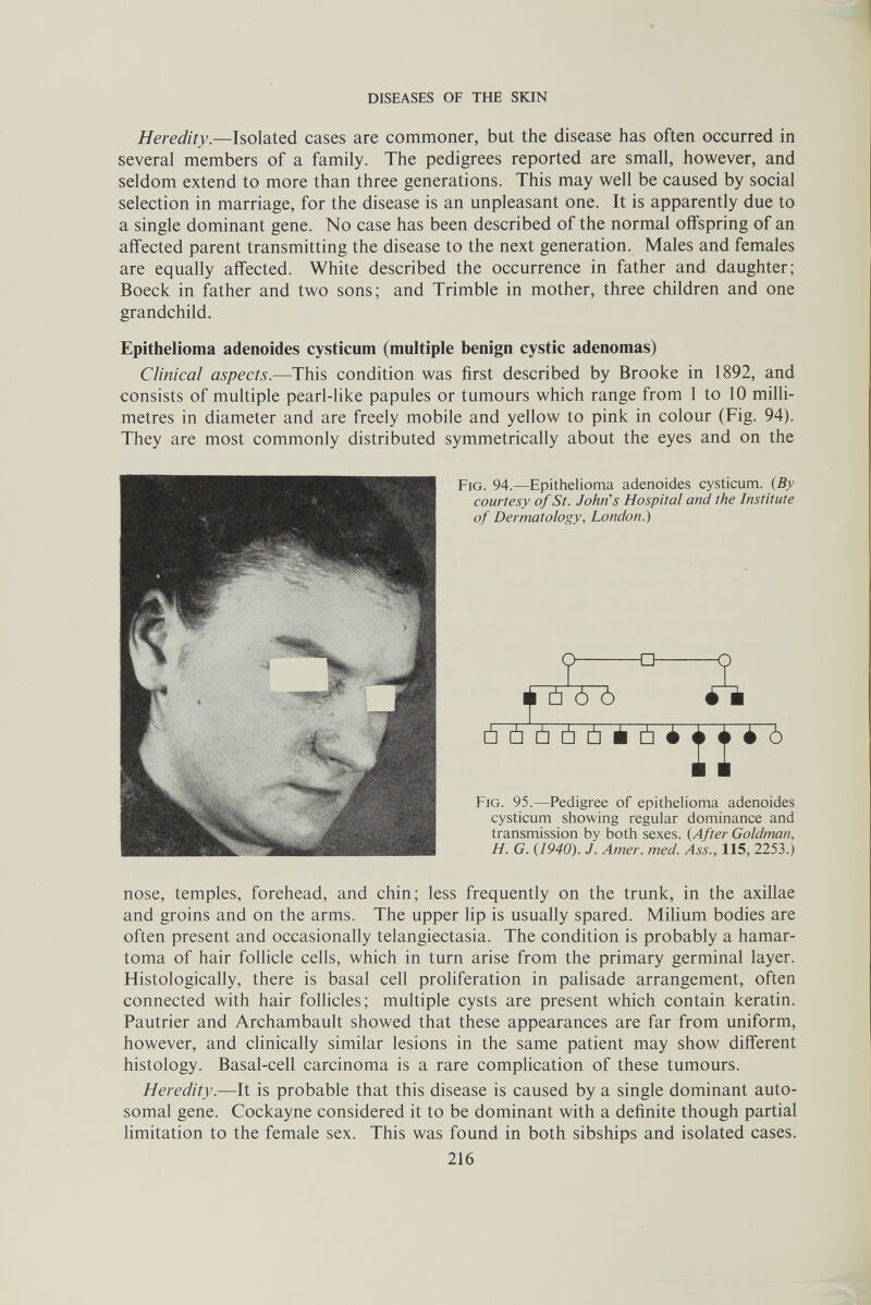 DISEASES OF THE SKIN Heredity.—Isolated cases are commoner, but the disease has often occurred in several members of a family. The pedigrees reported are small, however, and seldom extend to more than three generations. This may well be caused by social selection in marriage, for the disease is an unpleasant one. It is apparently due to a single dominant gene. No case has been described of the normal offspring of an affected parent transmitting the disease to the next generation. Males and females are equally affected. White described the occurrence in father and daughter; Boeck in father and two sons; and Trimble in mother, three children and one grandchild. Epithelioma adenoides cysticum (multiple benign cystic adenomas) Clinical aspects.—This condition was first described by Brooke in 1892, and consists of multiple pearl-like papules or tumours which range from 1 to 10 milli¬ metres in diameter and are freely mobile and yellow to pink in colour (Fig. 94). They are most commonly distributed symmetrically about the eyes and on the Fig. 94.—Epithelioma adenoides cysticum. {By courtesy of St. John's Hospital and the Institute of Dermatology, London.) o- -o- 1^ Ú Ó Ó ú ù ù ù ù à ù é 7. TV Ъ Fig. 95.—Pedigree of epithelioma adenoides cysticum showing regular dominance and transmission by both sexes. (After Goldman, H. G. {1940). J. Amer. med. Ллл'., 115, 2253.) nose, temples, forehead, and chin; less frequently on the trunk, in the axillae and groins and on the arms. The upper lip is usually spared. Milium bodies are often present and occasionally telangiectasia. The condition is probably a hamar¬ toma of hair follicle cells, which in turn arise from the primary germinal layer. Histologically, there is basal cell proliferation in palisade arrangement, often connected with hair follicles; multiple cysts are present which contain keratin. Pautrier and Archambault showed that these appearances are far from uniform, however, and clinically similar lesions in the same patient may show different histology. Basal-cell carcinoma is a rare complication of these tumours. Heredity.—It is probable that this disease is caused by a single dominant auto¬ somal gene. Cockayne considered it to be dominant with a definite though partial limitation to the female sex. This was found in both sibships and isolated cases. 216