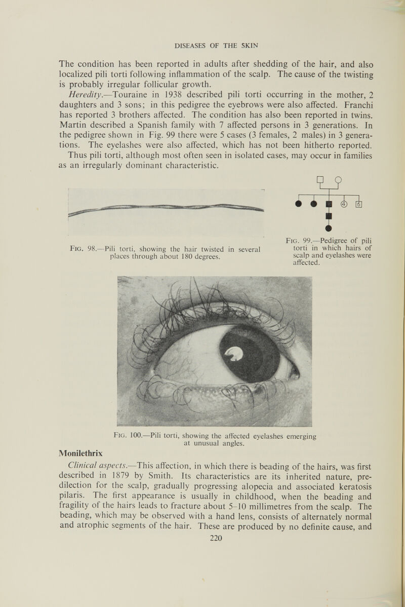 DISEASES OF THE SKIN The condition has been reported in adults after shedding of the hair, and also localized pili torti following inflammation of the scalp. The cause of the twisting is probably irregular follicular growth. Heredity.—Touraine in 1938 described pili torti occurring in the mother, 2 daughters and 3 sons; in this pedigree the eyebrows were also affected. Franchi has reported 3 brothers aff'ected. The condition has also been reported in twins. Martin described a Spanish family with 7 affected persons in 3 generations. In the pedigree shown in Fig. 99 there were 5 cases (3 females, 2 males) in 3 genera¬ tions. The eyelashes were also affected, which has not been hitherto reported. Thus pili torti, although most often seen in isolated cases, may occur in families as an irregularly dominant characteristic. Monilethrix Clinical aspects.—This affection, in which there is beading of the hairs, was first described in 1879 by Smith. Its characteristics are its inherited nature, pre¬ dilection for the scalp, gradually progressing alopecia and associated keratosis pilaris. The first appearance is usually in childhood, when the beading and fragility of the hairs leads to fracture about 5-10 millimetres from the scalp. The beading, which may be observed with a hand lens, consists of alternately normal and atrophic segments of the hair. These are produced by no definite cause, and Fig. 98.—Pili torti, showing the hair twisted in several places through about 180 degrees. Fig. 99.—Pedigree of pill torti in which hairs of scalp and eyelashes were affected. Fig. 100.—Pili torti, showing the affected eyelashes emerging at unusual angles. 220