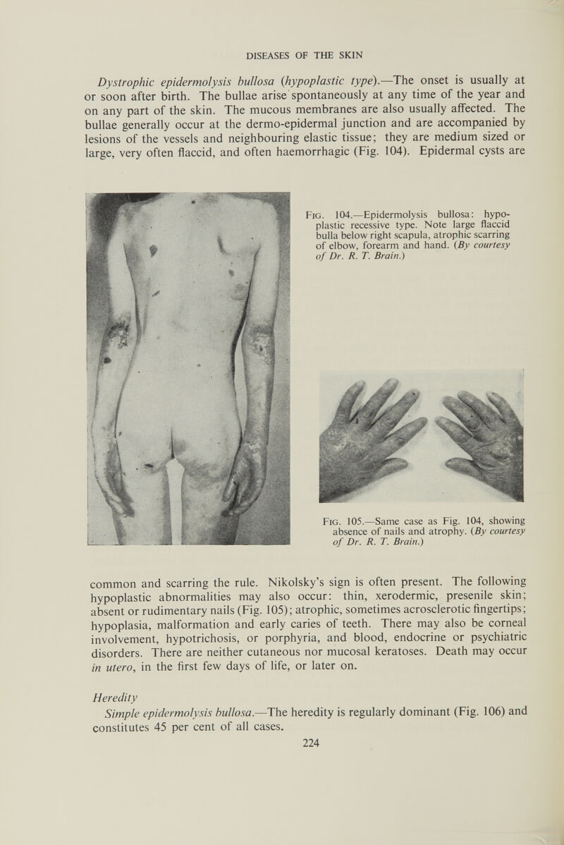 DISEASES OF THE SKIN Dystrophic epidermolysis bullosa {hypoplastic type).—The onset is usually at or soon after birth. The bullae arise spontaneously at any time of the year and on any part of the skin. The mucous membranes are also usually affected. The bullae generally occur at the dermo-epidermal junction and are accompanied by lesions of the vessels and neighbouring elastic tissue; they are medium sized or large, very often flaccid, and often haemorrhagic (Fig. 104). Epidermal cysts are Fig. 104.—Epidermolysis bullosa: hypo¬ plastic recessive type. Note large flaccid bulla below right scapula, atrophic scarring of elbow, forearm and hand. {By courtesy of Dr. R. T. Brain.) Fig. 105.—Same case as Fig. 104, showing absence of nails and atrophy. {By courtesy of Dr. R. T. Brain.) common and scarring the rule. Nikolsky's sign is often present. The following hypoplastic abnormalities may also occur; thin, xerodermic, presenile skin; absent or rudimentary nails (Fig. 105); atrophic, sometimes acrosclerotic fingertips; hypoplasia, malformation and early caries of teeth. There may also be corneal involvement, hypotrichosis, or porphyria, and blood, endocrine or psychiatric disorders. There are neither cutaneous nor mucosal keratoses. Death may occur in utero, in the first few days of life, or later on. Heredity Simple epidermolysis bullosa.—The heredity is regularly dominant (Fig. 106) and constitutes 45 per cent of all cases. 224 i