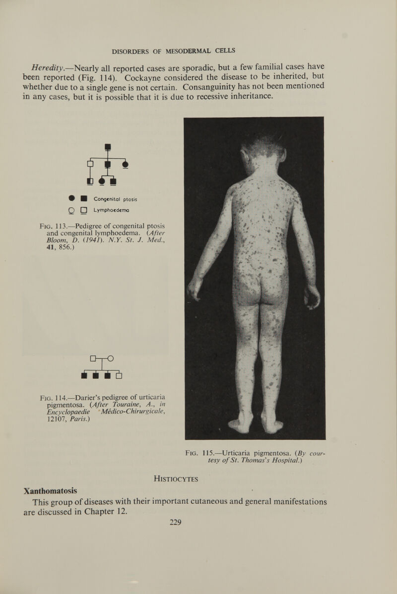 DISORDERS OF MESODERMAL CELLS Heredity.—Nearly all reported cases are sporadic, but a few familial cases have been reported (Fig. 114). Cockayne considered the disease to be inherited, but whether due to a single gene is not certain. Consanguinity has not been mentioned in any cases, but it is possible that it is due to recessive inheritance. V H Congenital ptosis Q □ Lymphocdemo Fig. 113.—Pedigree of congenital ptosis and congenital lymphoedema. {After Bloom, D. (1941). N.Y. St. J. Med., 41, 856.) D-r-O É É É Ú Fig. 114.—Darier's pedigree of urticaria pigmentosa. (After Touraine, A., in Encyclopaedie Médico-Chirurgicale, 12107, Paris.) Fig. 115.—Urticaria pigmentosa. {By cour¬ tesy of St. Thomas's Hospital.) Histiocytes Xanthomatosis This group of diseases with their important cutaneous and general manifestations are discussed in Chapter 12. 229