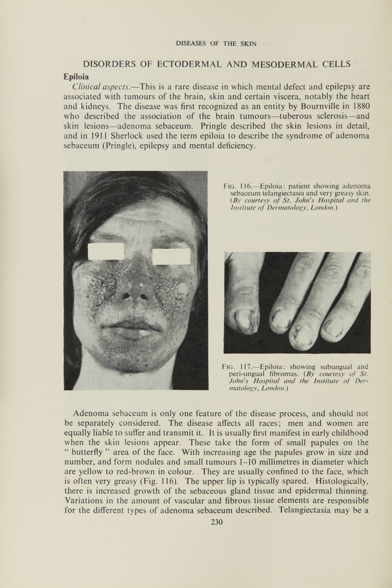 DISEASES OF TUE SKIN DISORDERS OF ECTODERMAL AND MESODERMAL CELLS Epiloia Clinical aspects.—This is a rare disease in which mental defect and epilepsy are associated with tumours of the brain, skin and certain viscera, notably the heart and kidneys. The disease was first recognized as an entity by Bournville in 1880 who described the association of the brain tumours—tuberous sclerosis—and skin lesions—adenoma sebaceum. Pringle described the skin lesions in detail, and in 1911 Sherlock used the term epiloia to describe the syndrome of adenoma sebaceum (Pringle), epilepsy and mental deficiency. Fig. 116.—Epiloia; patient showing adenoma sebaceum telangiectasia and very greasy skin. {By courtesy of St. John's Hospital and the Institute of Dermatology, London.) Fig. 117.—Epiloia: showing subungual and peri-ungual fibromas. {By courtesy of St. John's Hospital and the Institute of Der¬ matology, London.) Adenoma sebaceum is only one feature of the disease process, and should not be separately considered. The disease affects all races; men and women are equally liable to suffer and transmit it. It is usually first manifest in early childhood when the skin lesions appear. These take the form of small papules on the  butterfly  area of the face. With increasing age the papules grow in size and number, and form nodules and small tumours 1-10 millimetres in diameter which are yellow to red-brown in colour. They are usually confined to the face, which is often very greasy (Fig. 116). The upper Ир is typically spared. Histologically, there is increased growth of the sebaceous gland tissue and epidermal thinning. Variations in the amount of vascular and fibrous tissue elements are responsible for the different types of adenoma sebaceum described. Telangiectasia may be a 230