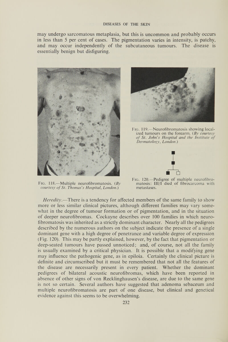 DISEASES OF THE SKIN may undergo sarcomatous metaplasia, but this is uncommon and probably occurs in less than 5 per cent of cases. The pigmentation varies in intensity, is patchy, and may occur independently of the subcutaneous tumours. The disease is essentially benign but disfiguring. Fig. 118.—Multiple neurofibromatosis. {By courtesy of St. Thomas's Hospital, London.) Fig. 119.—Neurofibromatosis showing local¬ ized tumours on the forearm. {By courtesy of St. John's Hospital and the Institute of Dermatology, London.) A Fig. 120.—Pedigree of multiple neurofibro¬ matosis; III/I died of fibrocarcoma with metastases. Heredity.—There is a tendency for affected members of the same family to show more or less similar chnical pictures, although different famihes may vary some¬ what in the degree of tumour formation or of pigmentation, and in the situation of deeper neurofibromas. Cockayne describes over 100 famihes in which neuro¬ fibromatosis was inherited as a strictly dominant character. Nearly all the pedigrees described by the numerous authors on the subject indicate the presence of a single dominant gene with a high degree of penetrance and variable degree of expression (Fig. 120). This may be partly explained, however, by the fact that pigmentation or deep-seated tumours have passed unnoticed; and, of course, not all the family is usually examined by a critical physician. It is possible that a modifying gene may influence the pathogenic gene, as in epiloia. Certainly the clinical picture is definite and circumscribed but it must be remembered that not all the features of the disease are necessarily present in every patient. Whether the dominant pedigrees of bilateral acoustic neurofibromas, which have been reported in absence of other signs of von Recklinghausen's disease, are due to the same gene is not so certain. Several authors have suggested that adenoma sebaceum and multiple neurofibromatosis are part of one disease, but clinical and genetical evidence against this seems to be overwhelming. 232