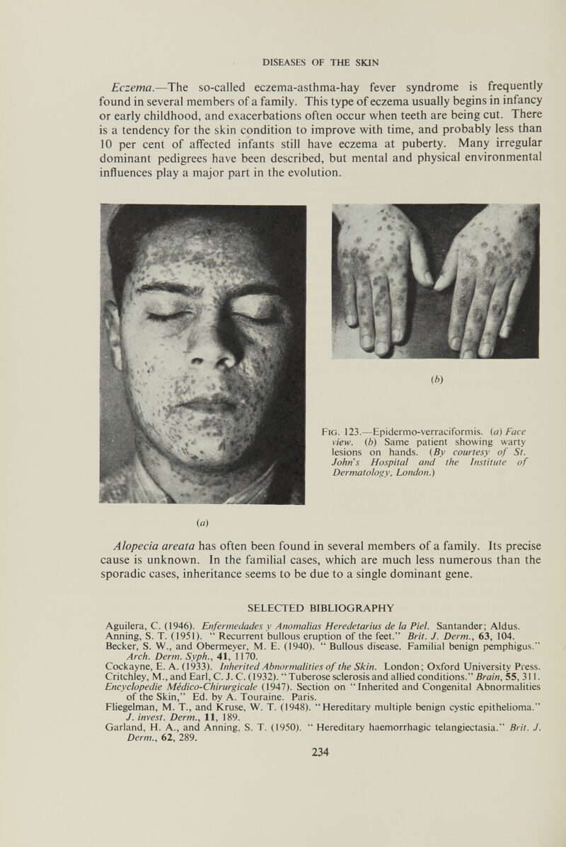 DISEASES OF THE SKIN Eczema.—The so-called eczema-asthma-hay fever syndrome is frequently found in several members of a family. This type of eczema usually begins in infancy or early childhood, and exacerbations often occur when teeth are being cut. There is a tendency for the skin condition to improve with time, and probably less than 10 per cent of affected infants still have eczema at puberty. Many irregular dominant pedigrees have been described, but mental and physical environmental influences play a major part in the evolution. Ф) Fig. 123.—Epidermo-verraciformis. {a) Face view, (b) Same patient showing warty lesions on hands. (By courtesy of St. John's Hospital and the Institute of Dermatology, London.) ia) Alopecia areata has often been found in several members of a family. Its precise cause is unknown. In the familial cases, which are much less numerous than the sporadic cases, inheritance seems to be due to a single dominant gene. SELECTED BIBLIOGRAPHY Aguilera, С. (1946). Enfermedades у Anomalías Heredetarius de la Piel. Santander; Aldus. Anning, S. T. (1951).  Recurrent bullous eruption of the feet. Brit. J. Derm., 63, 104. Becker, S. W., and Obermeyer, M. E. (1940). Bullous disease. Familial benign pemphigus. Arch. Derm. Syph., 41, 1170. Cockayne, E. A. (1933). Inherited Abnormalities of the Skin. London; Oxford University Press. Critchley, M., and Earl, C. J. C. (1932). Tuberose sclerosis and allied conditions. Brain, 55, 311. Encyclopédie Médico-Chirurgicale (1947). Section on  Inherited and Congenital Abnormalities of the Skin, Ed. by A. Touraine. Paris. Fliegelman, M. T., and Kruse, W. T. (1948). Hereditary multiple benign cystic epithelioma. J. invest. Derm., 11, 189. Garland, H. A., and Anning, S. T. (1950).  Hereditary haemorrhagic telangiectasia. Brit. J. Derm., 62, 289. 234