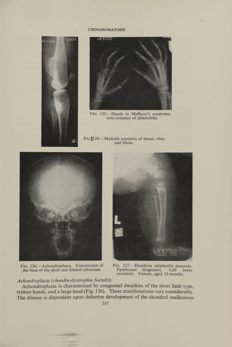 CHONDROMATOSES Fig. 126.—Achondroplasia. Constriction of Fig. 127.—Dysplasia epiphysitis punctata, the base of the skull and dilated calvarium. Epiphyseal dysgenesis. Left lower extremity. Female, aged 10 months. Achondroplasia (chondro-dystrophia foetalis) Achondroplasia is characterized by congenital dwarfism of the short limb type, trident hands, and a large head (Fig. 126). These manifestations vary considerably. The disease is dependent upon defective development of the chondral ossification 237