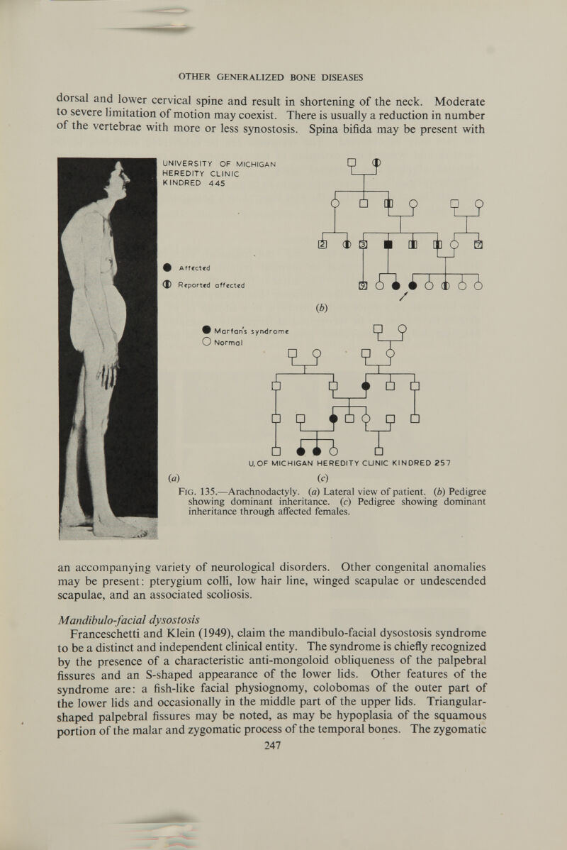 OTHER GENERALIZED BONE DISEASES dorsal and lower cervical spine and result in shortening of the neck. Moderate to severe limitation of motion may coexist. There is usually a reduction in number of the vertebrae with more or less synostosis. Spina bifida may be present with UNIVERSITY OF MICHIGAN HEREDITY CLINIC KINDRED 445 ¿ 5 Íq P Q Í i CO 11 Ï 4 Щ Arrected d) Reporttd offected Й ii 4 ¿ (i) ¿ ¿ / (b) Ф Marfans syndrome О Normal V о 6 ^ ^ ¿ Ù □ □ hb □ □ (a) UOF MICHIGAN HEREDITY CUNIC KINDRED 257 (c) Fig. 135.—АгасЬлойас1у1у. (a) Lateral view of patient, (ô) Pedigree showing dominant inheritance, (c) Pedigree showing dominant inheritance through affected females. an accompanying variety of neurological disorders. Other congenital anomalies may be present: pterygium colli, low hair line, winged scapulae or undescended scapulae, and an associated scohosis. Mandibulo-facial dysostosis Franceschetti and Klein (1949), claim the mandibulo-facial dysostosis syndrome to be a distinct and independent clinical entity. The syndrome is chiefly recognized by the presence of a characteristic anti-mongoloid obhqueness of the palpebral fissures and an S-shaped appearance of the lower Hds. Other features of the syndrome are: a fish-like facial physiognomy, colobomas of the outer part of the lower lids and occasionally in the middle part of the upper lids. Triangular- shaped palpebral fissures may be noted, as may be hypoplasia of the squamous portion of the malar and zygomatic process of the temporal bones. The zygomatic 247