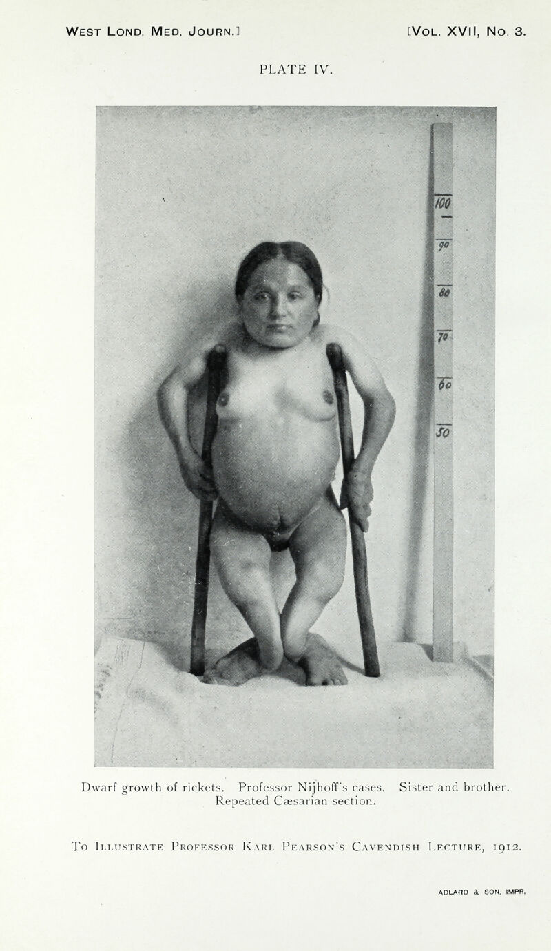 West Lond. Med. Journ.] [Vol. XVII, No. 3. PLATE IV. Dwarf growth of rickets. Professor Nijhoff's cases. Sister and brother. Repeated Caesarian section. To Illustrate Professor Karl Pearson's Cavendish Lecture, 1912. ADLAOD St SON. IMPR.