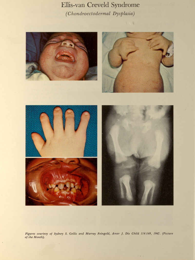 Ellis-van Creveld Syndrome (Chondroectodermal Dysplasia) Figures courtesy of Sydney S. Gellis and Murray Feingold, Amer J. Dis Child 114:169, 1967. (Picture of the Month).