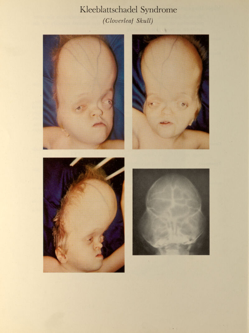 Kleeblattschadel Syndrome (Cloverleaf Skull)