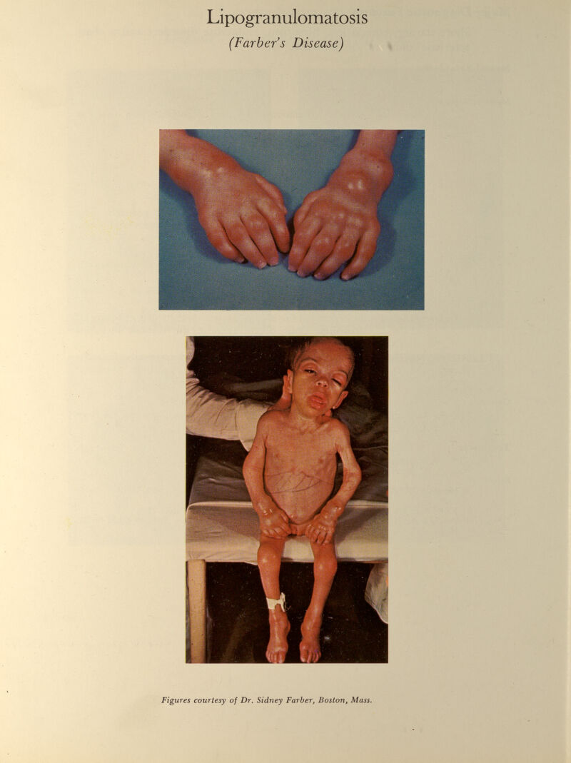 Lipogranulomatosis (Färber s Disease) Figures courtesy of Dr. Sidney Färber, Boston, Mass.