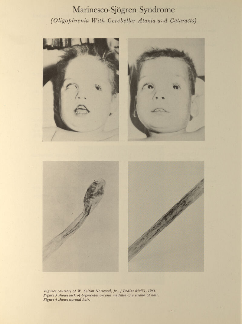 Marinesco-Sjogren Syndrome (Oligophrenia With Cerebellar Ataxia and Cataracts) Figures courtesy of W. Felton Norwood, Jr., J Pediat 65:431, 1964. Figure 3 shows lack of pigmentation and medulla of a strand of hair. Figure 4 shows normal hair.