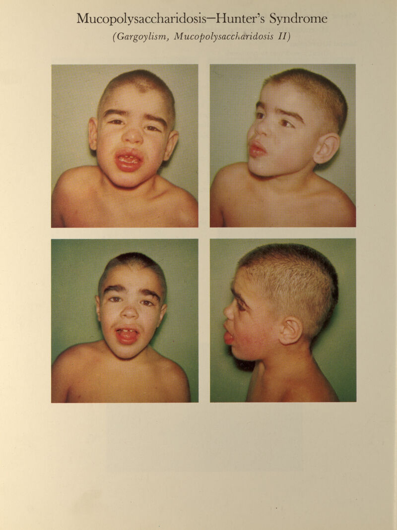 Mucopolysaccharidosis—Hunter’s Syndrome (Gargoylism, Mucopolysaccharidosis II)