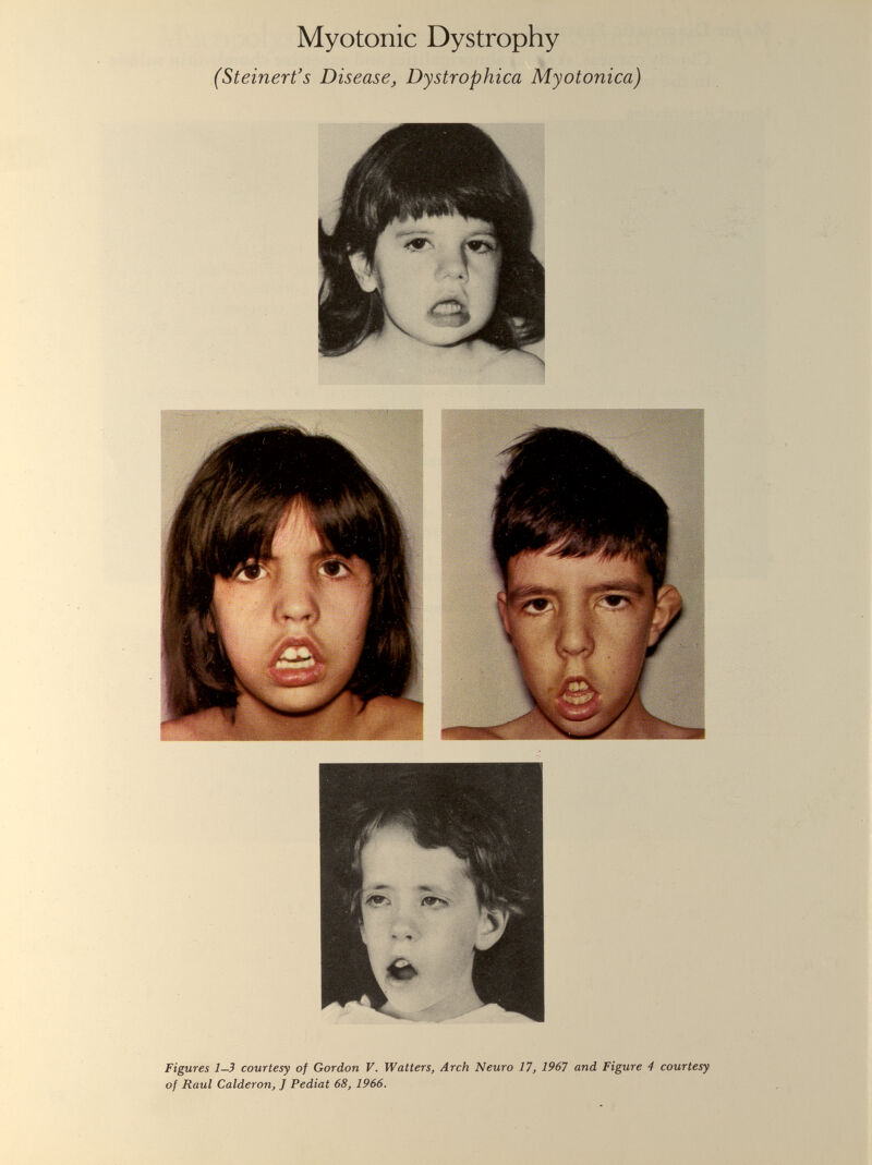 Myotonic Dystrophy (Steinert’s Disease, Dystrophica Myotonica) Figures 1—3 courtesy of Gordon V. Watters, Arch Neuro 17, 1967 and Figure 4 courtesy of Raul Calderon, J Pediat 68, 1966.