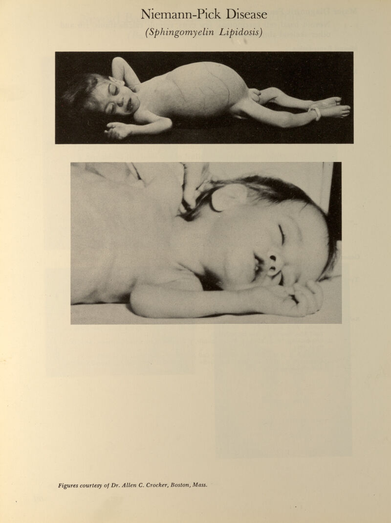 Niemann-Pick Disease (Sphingomyelin Lipidosis)