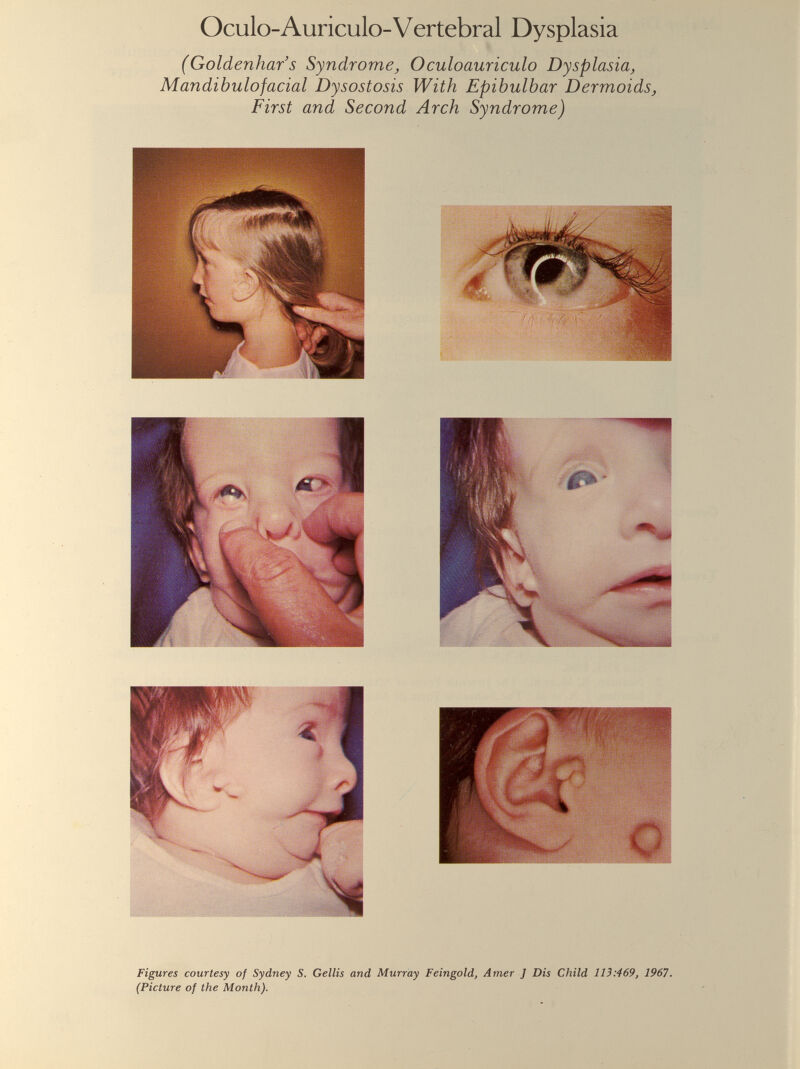 Oculo-Auriculo-Vertebral Dysplasia (Goldenhar’s Syndrome, Oculoauriculo Dysplasia, Mandibulofacial Dysostosis With Epibulbar Dermoids, First and Second Arch Syndrome) Figures courtesy of Sydney S. Gellis and Murray Feingold, Amer J Dis Child 113:469, 1967. (Picture of the Month).