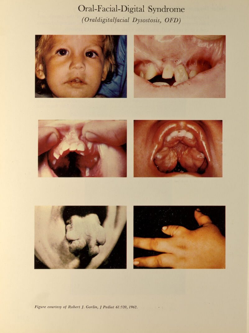 Oral-Facial-Digital Syndrome (Oraldigitalfacial Dysostosis, OFD)