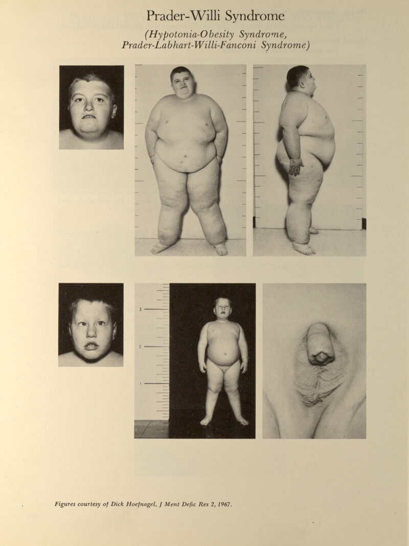 Prader-Willi Syndrome (Hypotonia-Obesity Syndrome, Prader-Labhart-Willi-Fanconi Syndrome)