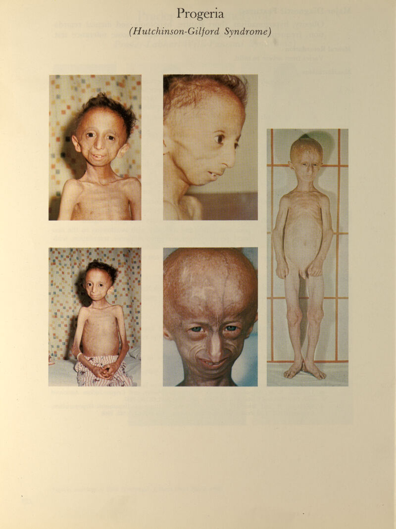 Progeria (Hutchinson-Gilford Syndrome)