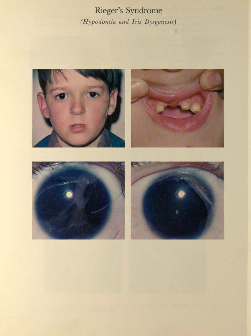 Rieger’s Syndrome (Hypodontia and Iris Dysgenesis)