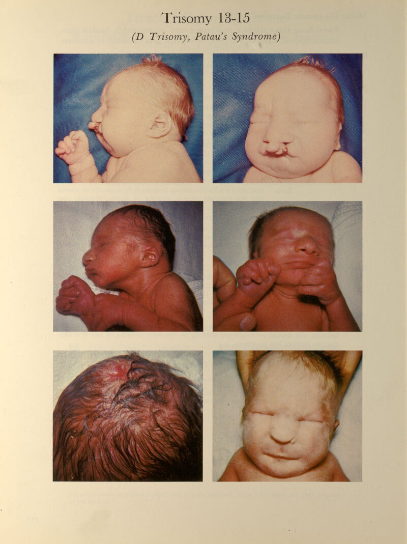 Trisomy 13-15 (D Trisomy, Patau’s Syndrome)