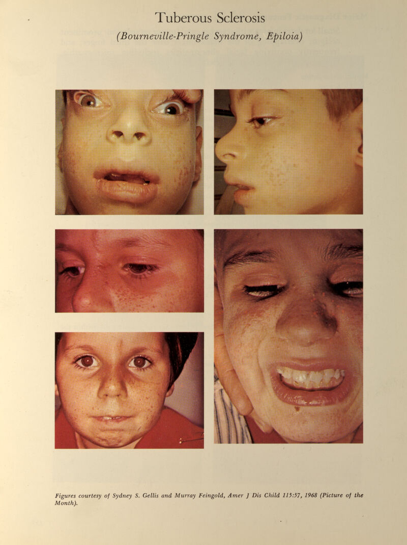 Tuberous Sclerosis (Bourneville-Pringle Syndrome, Epiloia)