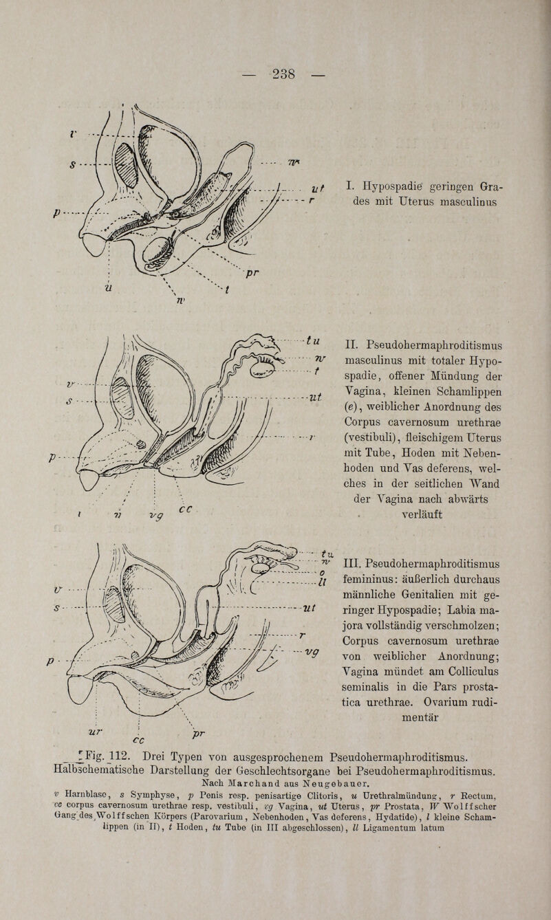 — 238 — 11 -^9 cc П. Pseudohermaphroditismus masculinus mit totaler Hypo- spadie, offener Mündung der Vagina, kleinen Schamlippen (e), weiblicher Anordnung des Corpus cavernosum urethrae (vestibuli), fleischigem Uterus mit Tube, Hoden mit Neben¬ hoden und Vas deferens, wel¬ ches in der seitlichen Wand der Vagina nach abwärts verläuft tu. / / Pseudohermaphroditismus yi j Ii femininus : äußerlich durchaus ^ ^ männliche Genitalien mit ge-  v,t ringer Hypospadia; Labia ma- /j jora vollständig verschmolzen;  Corpus cavernosum urethrae /у А von weiblicher Anordnung; I Vagina mündet am Colliculus seminalis in die Pars prosta¬ tica urethrae. Ovarium rudi¬ mentär Tir cc pr TFig. 112. Drei Typen von ausgesprochenem Pseudohermaphroditismus. Halbschematische Darstellung der Geschlechtsorgane bei Pseudohermaphroditismus. Nach Marchand aus Neugebauer. V Harnblase, s Symphyse, p Penis resp. penisartige Clitoris, и Urethralmündung, r Eectum, CB corpus cavernosum urethrae resp. vestibuli, tg Vagina, ut Uterus, pr Prostata, IF Wo 1 ffscher tìang des^Wolffsehen Körpers (Parovarium, Nebenhoden, Vas deferens, Hydatide), l kleine Scham¬ lippen (in II), t Hoden, tu Tube (in III abgeschlossen), II Ligamentum latum