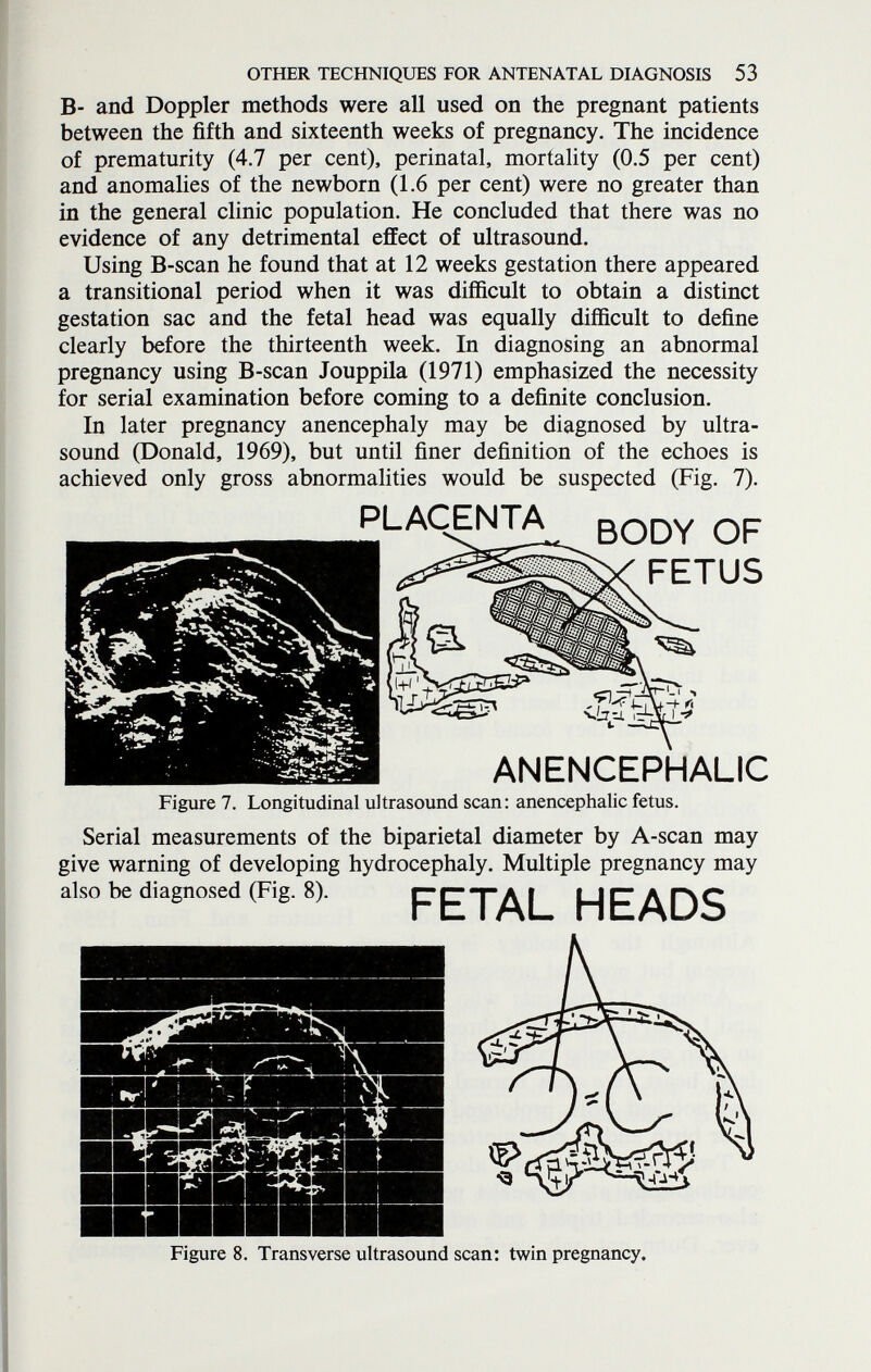 OTHER TECHNIQUES FOR ANTENATAL DIAGNOSIS 53 B- and Doppler methods were all used on the pregnant patients between the fifth and sixteenth weeks of pregnancy. The incidence of prematurity (4.7 per cent), perinatal, mortality (0.5 per cent) and anomalies of the newborn (1.6 per cent) were no greater than in the general clinic population. He concluded that there was no evidence of any detrimental efiiect of ultrasound. Using B-scan he found that at 12 weeks gestation there appeared a transitional period when it was difficult to obtain a distinct gestation sac and the fetal head was equally difficult to define clearly before the thirteenth week. In diagnosing an abnormal pregnancy using B-scan Jouppila (1971) emphasized the necessity for serial examination before coming to a definite conclusion. In later pregnancy anencephaly may be diagnosed by ultra¬ sound (Donald, 1969), but until finer definition of the echoes is achieved only gross abnormalities would be suspected (Fig. 7). PLACENTA BODY OF FETUS ANENCEPHALIC Figure 7. Longitudinal ultrasound scan: anencephalic fetus. Serial measurements of the biparietal diameter by A-scan may give warning of developing hydrocephaly. Multiple pregnancy may also be diagnosed (Fig. 8). FETAL HEADS Figure 8. Transverse ultrasound scan: twin pregnancy.