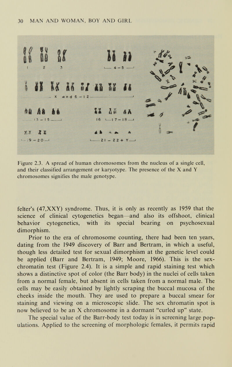 30 MAN AND WOMAN, BOY AND GIRL • í !! il U ii ii 4-5 \ II Äii в/ 16 S¡¡ II ^ i. . >« • » -X C»fid6-I2 itII hu li U 2ií «A Л 13-15 ——1 161—17-18 —1 i  f KXiat la» _ ; 9 - 2 o -J i—- 2 1 - 2 2+ Y « Figure 2.3. A spread of human chromosomes from the nucleus of a single cell, and their classified arrangement or karyotype. The presence of the X and Y chromosomes signifies the male genotype. felter's (47,XXY) syndrome. Thus, it is only as recently as 1959 that the science of clinical cytogenetics began—and also its offshoot, clinical behavior cytogenetics, with its special bearing on psychosexual dimorphism. Prior to the era of chromosome counting, there had been ten years, dating from the 1949 discovery of Barr and Bertram, in which a useful, though less detailed test for sexual dimorphism at the genetic level could be applied (Barr and Bertram, 1949; Moore, 1966). This is the sex- chromatin test (Figure 2.4). It is a simple and rapid staining test which shows a distinctive spot of color (the Barr body) in the nuclei of cells taken from a normal female, but absent in cells taken from a normal male. The cells may be easily obtained by lightly scraping the buccal mucosa of the cheeks inside the mouth. They are used to prepare a buccal smear for staining and viewing on a microscopic slide. The sex chromatin spot is now believed to be an X chromosome in a dormant curled up state. The special value of the Barr-body test today is in screening large pop¬ ulations. Applied to the screening of morphologic females, it permits rapid