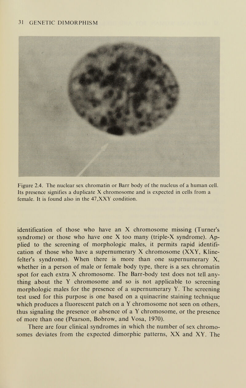 31 GENETIC DIMORPHISM Figure 2.4. The nuclear sex chromatin or Barr body of the nucleus of a human cell. Its presence signifies a duplicate X chromosome and is expected in cells from a female. It is found also in the 47,XXY condition. identification of those who have an X chromosome missing (Turner's syndrome) or those who have one X too many (triple-X syndrome). Ap¬ plied to the screening of morphologic males, it permits rapid identifi¬ cation of those who have a supernumerary X chromosome (XXY, Kline- felter's syndrome). When there is more than one supernumerary X, whether in a person of male or female body type, there is a sex chromatin spot for each extra X chromosome. The Barr-body test does not tell any¬ thing about the Y chromosome and so is not applicable to screening morphologic males for the presence of a supernumerary Y. The screening test used for this purpose is one based on a quinacrine staining technique which produces a fluorescent patch on a Y chromosome not seen on others, thus signaling the presence or absence of a Y chromosome, or the presence of more than one (Pearson, Bobrow, and Vosa, 1970). There are four clinical syndromes in which the number of sex chromo¬ somes deviates from the expected dimorphic patterns, XX and XY. The