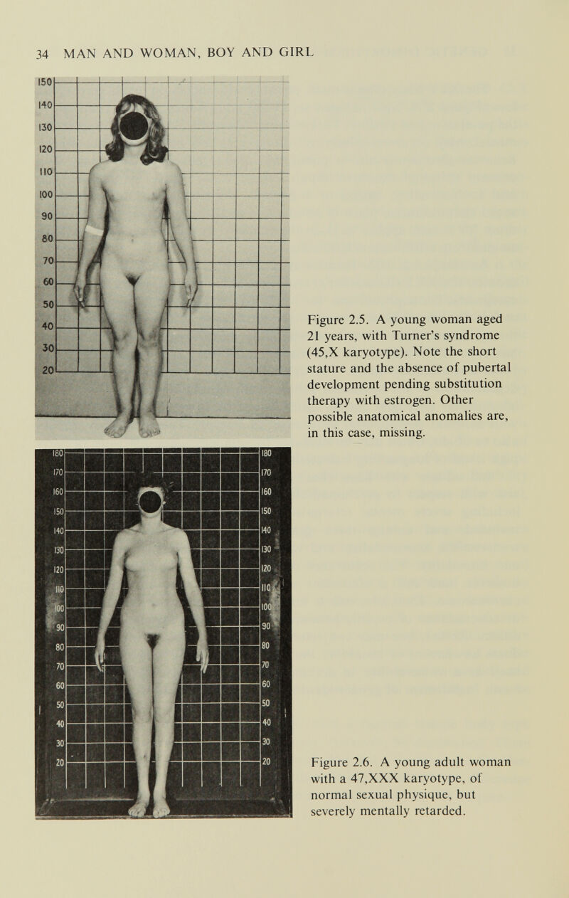 34 MAN AND WOMAN, BOY AND GIRL Figure 2.5. A young woman aged 21 years, with Turner's syndrome (45,X karyotype). Note the short stature and the absence of pubertal development pending substitution therapy with estrogen. Other possible anatomical anomalies are, in this case, missing. Figure 2.6. A young adult woman with a 47,XXX karyotype, of normal sexual physique, but severely mentally retarded.