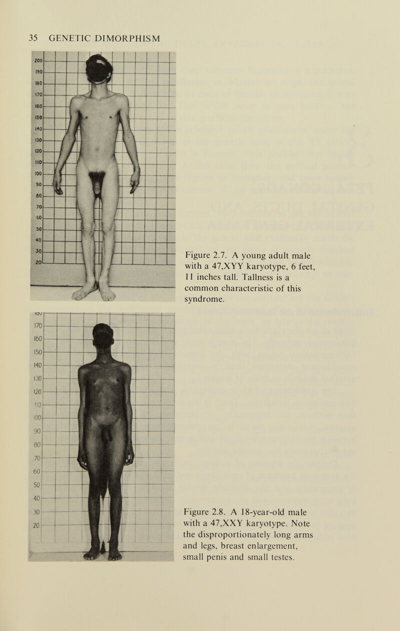 Figure 2.7. A young adult male with a 47,XYY karyotype, 6 feet, 11 inches tall. Tallness is a common characteristic of this syndrome. Figure 2.8. A 18-year-old male with a 47,XXY karyotype. Note the disproportionately long arms and legs, breast enlargement, small penis and small testes.