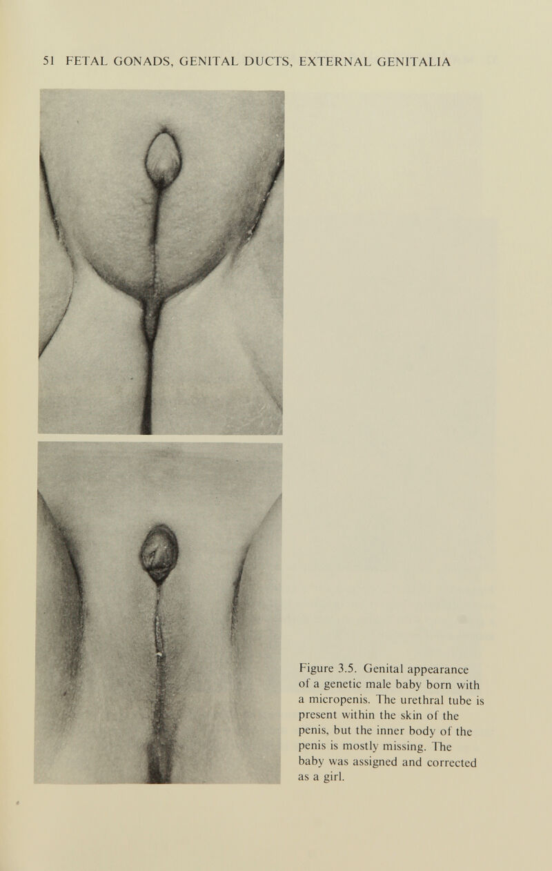 51 FETAL GONADS, GENITAL DUCTS, EXTERNAL GENITALIA lÄf#- Figure 3.5. Genital appearance of a genetic male baby born with a micropenis. The urethral tube is present within the skin of the penis, but the inner body of the penis is mostly missing. The baby was assigned and corrected as a girl.