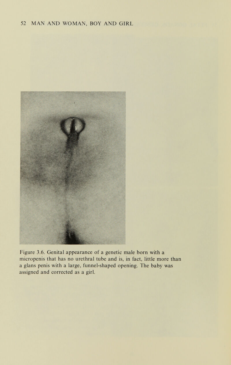 52 MAN AND WOMAN, BOY AND GIRL Figure 3.6. Genital appearance of a genetic male born with a micropenis that has no urethral tube and is, in fact, little more than a glans penis with a large, funnel-shaped opening. The baby was assigned and corrected as a girl.