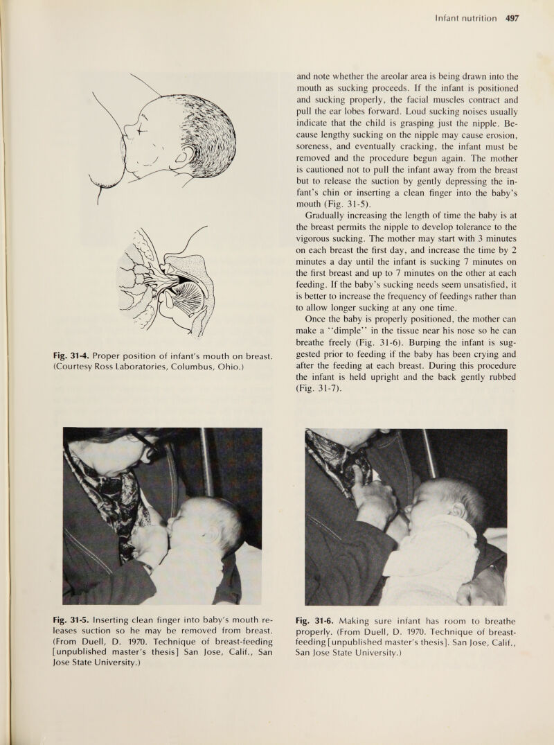 Infant nutrition 497 Fig. 31-4. Proper position of infant's mouth on breast. (Courtesy Ross Laboratories, Columbus, Ohio.) Fig. 31-5. Inserting clean finger into baby's mouth re¬ leases suction so he may be removed from breast. (From Duell, D. 1970. Technique of breast-feeding [unpublished master's thesis] San Jose, Calif., San Jose State University.) and note whether the areolar area is being drawn into the mouth as sucking proceeds. If the infant is positioned and sucking properly, the facial muscles contract and pull the ear lobes forward. Loud sucking noises usually indicate that the child is grasping just the nipple. Be¬ cause lengthy sucking on the nipple may cause erosion, soreness, and eventually cracking, the infant must be removed and the procedure begun again. The mother is cautioned not to pull the infant away from the breast but to release the suction by gently depressing the in¬ fant's chin or inserting a clean finger into the baby's mouth (Fig. 31-5). Gradually increasing the length of time the baby is at the breast permits the nipple to develop tolerance to the vigorous sucking. The mother may start with 3 minutes on each breast the first day, and increase the time by 2 minutes a day until the infant is sucking 7 minutes on the first breast and up to 7 minutes on the other at each feeding. If the baby's sucking needs seem unsatisfied, it is better to increase the frequency of feedings rather than to allow longer sucking at any one time. Once the baby is properly positioned, the mother can make a dimple in the tissue near his nose so he can breathe freely (Fig. 31-6). Buфing the infant is sug¬ gested prior to feeding if the baby has been crying and after the feeding at each breast. During this procedure the infant is held upright and the back gently rubbed (Fig. 31-7). Fig. 31-6. Making sure infant has room to breathe properly. (From Duell, D. 1970. Technique of breast¬ feeding [unpublished master's thesis]. San Jose, Calif., San Jose State University.)