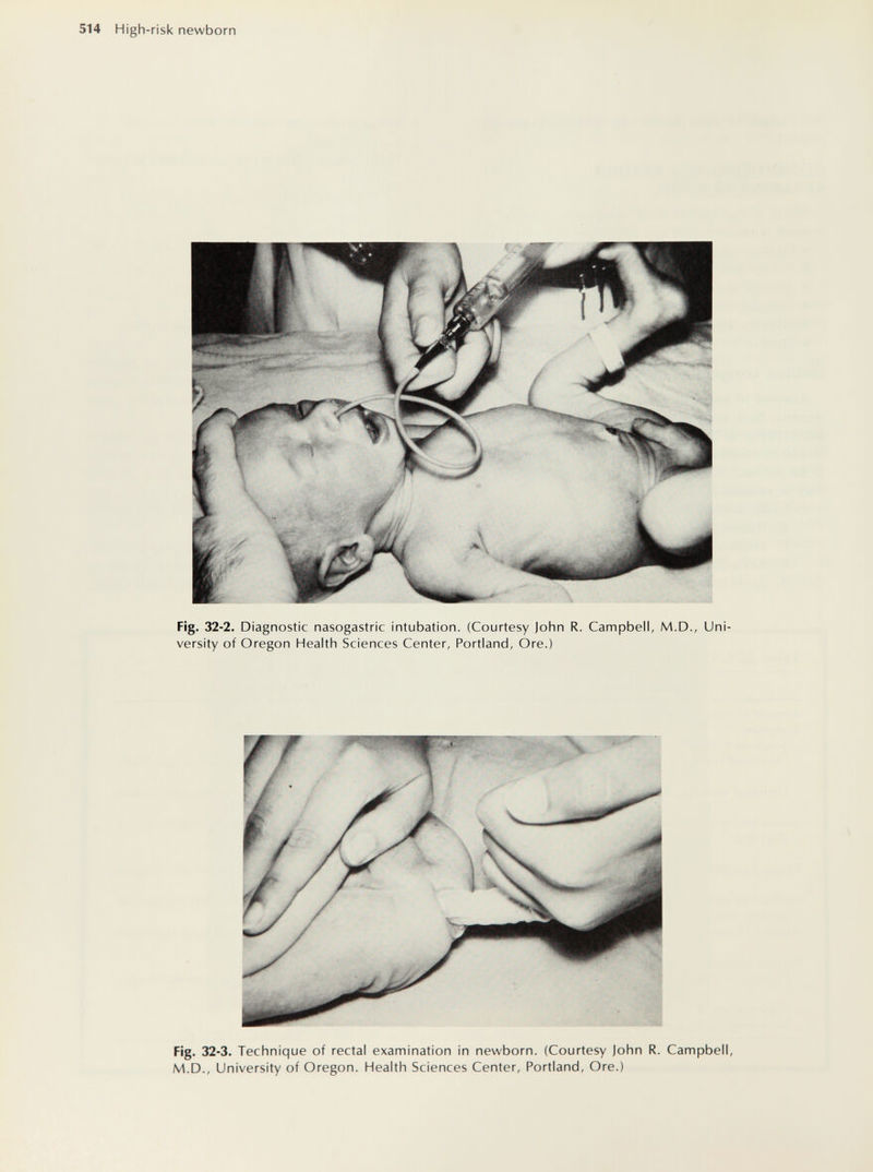 514 High- risk newborn Fig. 32-2. Diagnostic nasogastric intubation. (Courtesy John R. Campbell, M.D., Uni¬ versity of Oregon Health Sciences Center, Portland, Ore.) Fig. 32-3. Technique of rectal examination in newborn. (Courtesy John R. Campbell, M.D., University of Oregon. Health Sciences Center, Portland, Ore.)