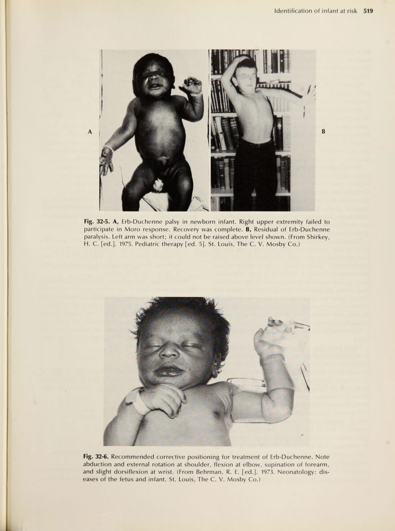 Identification of infant at risk 519 Fig. 32-5. A, Erb-Duchenne palsy in newborn infant. Right upper extremity failed to participate in Moro response. Recovery was complete. B, Residual of Erb-Duchenne paralysis. Left arm was short; it could not be raised above level shown. (From Shirkey, H. C. [ed.]. 1975. Pediatric therapy [ed. 5]. St. Louis, The C. V. Mosby Co.) Fig. 32-6. Recommended corrective positioning for treatment of Erb-Duchenne. Note abduction and external rotation at shoulder, flexion at elbow, supination of forearm, and slight dorsiflexion at wrist. (From Behrman, R. E. [ed.]. 1973. Neonatology: dis¬ eases of the fetus and infant. St. Louis, The C. V. Mosby Co.)
